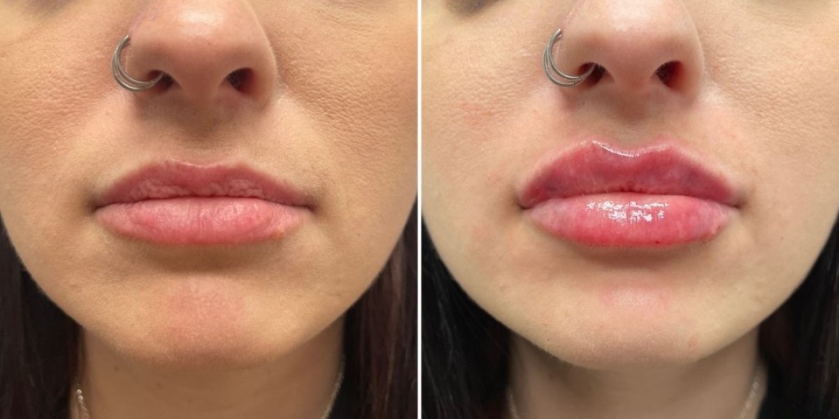 Perfect Lip Augmentation in Islamabad