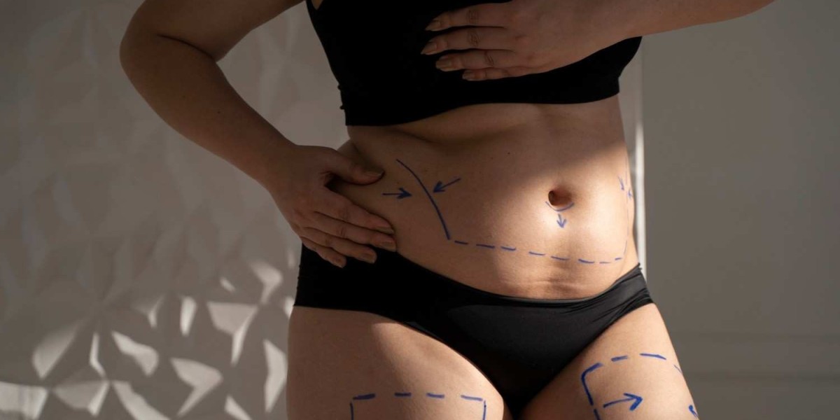 Remarkable Bariatric Surgery in Islamabad