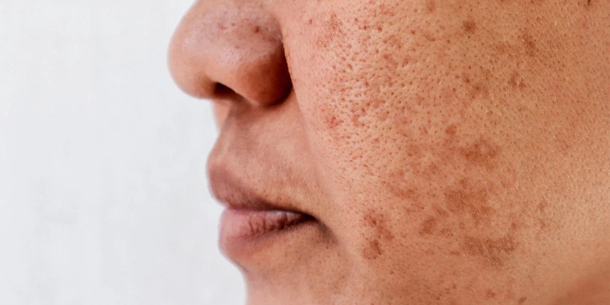 Brighten Your Skin with Melasma Care