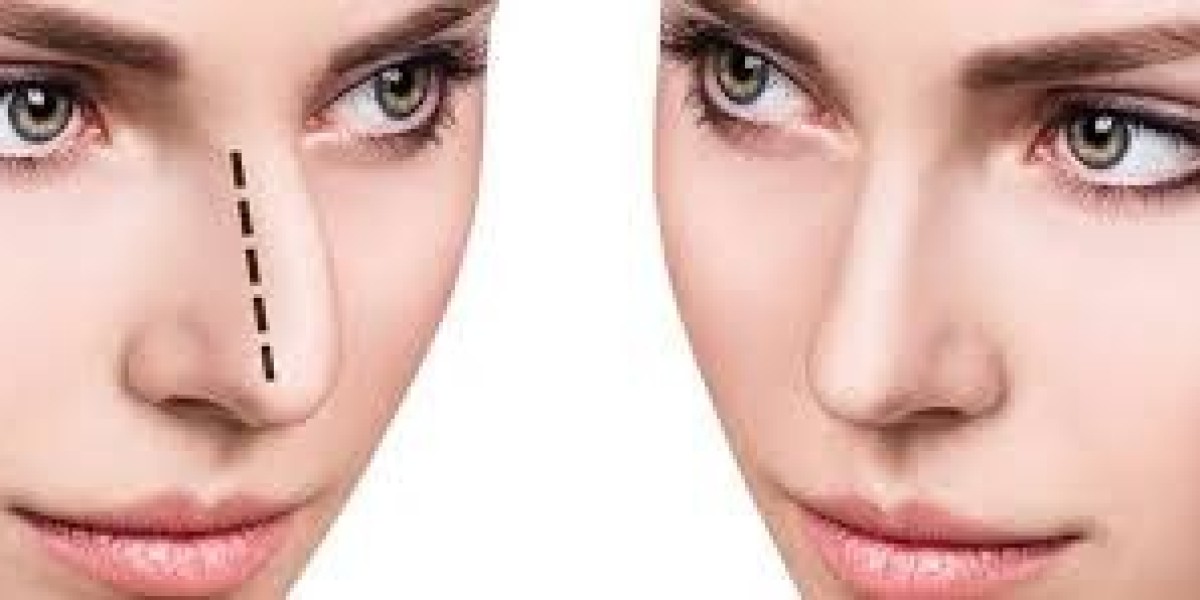 Common Myths About Rhinoplasty in Pakistan Debunked