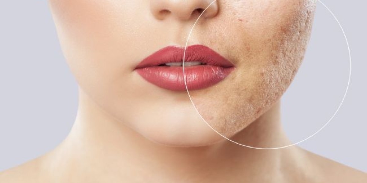 Large Pore Treatment Procedures in Islamabad