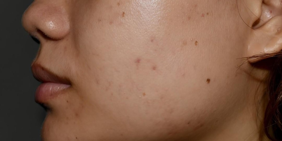 Flawless Skin Hyperpigmentation Treatment Islamabad