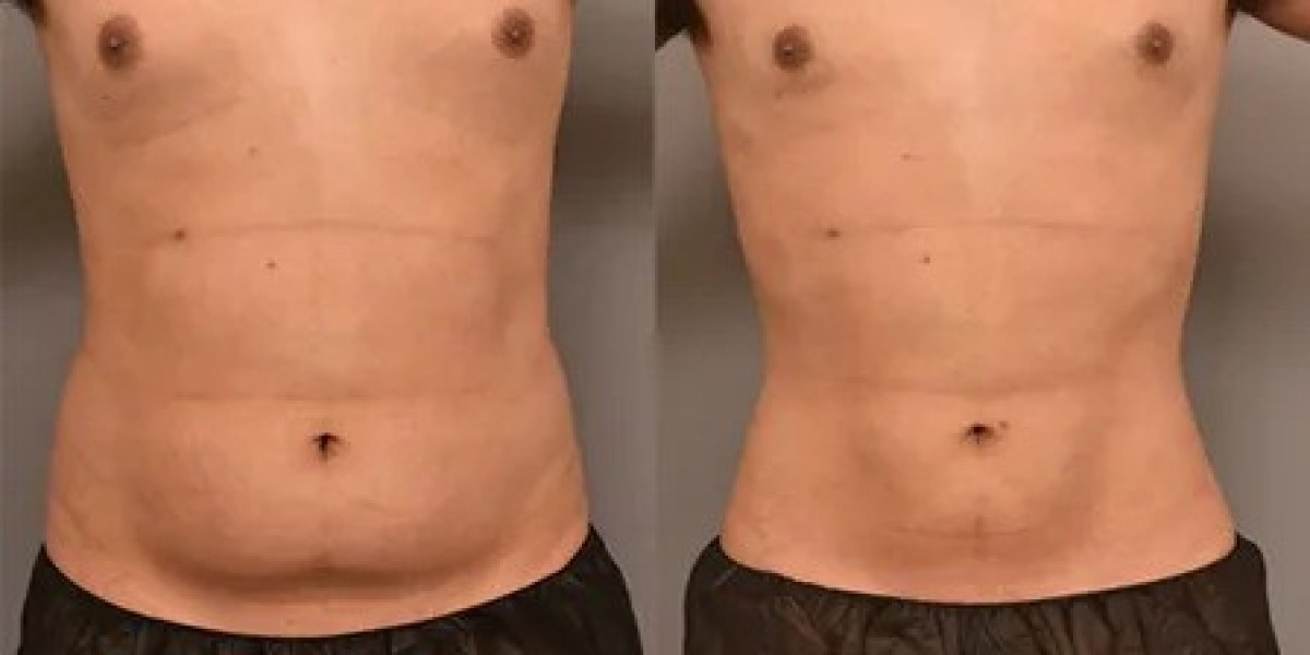 Liposuction in Islamabad: From Consultation to Recovery