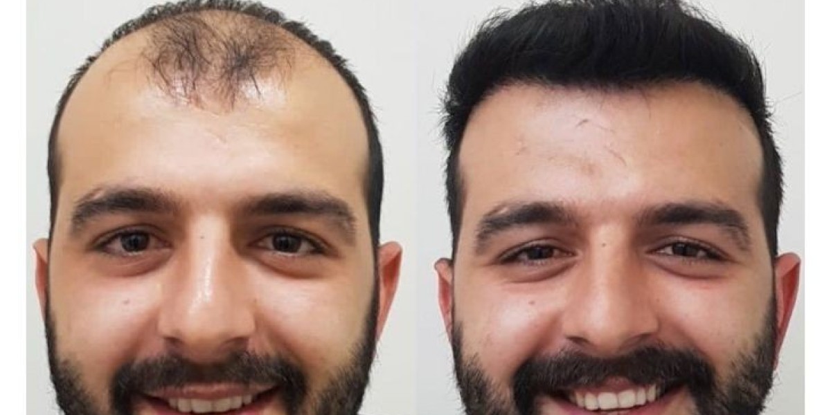 Hair Transplant in Islamabad: Cost Factors and How to Plan