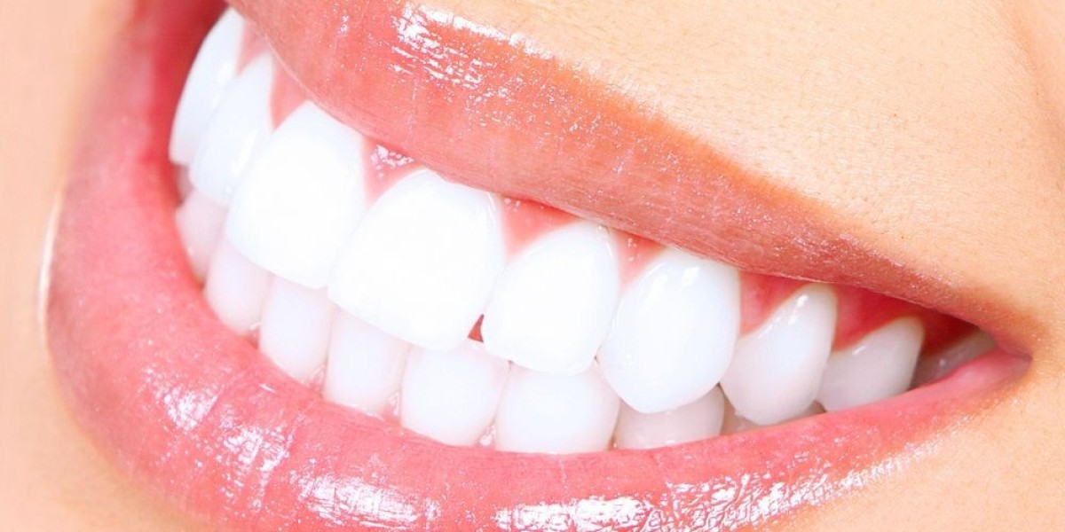 Teeth Whitening in Islamabad: Common Post-Treatment Issues