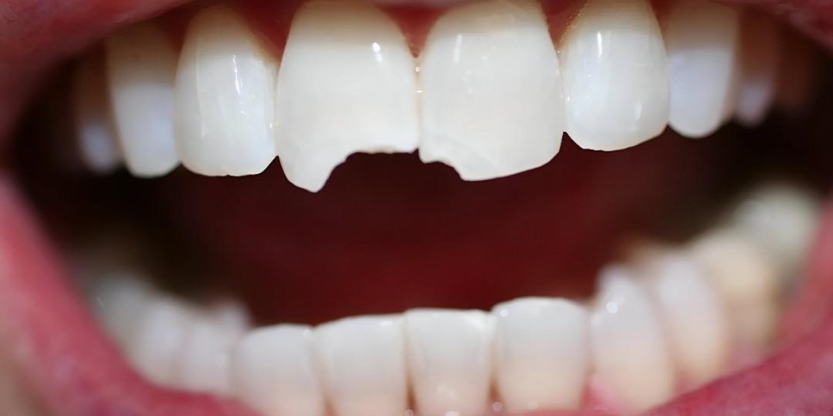 Teeth Fracture Treatment in Islamabad | Trusted Healing
