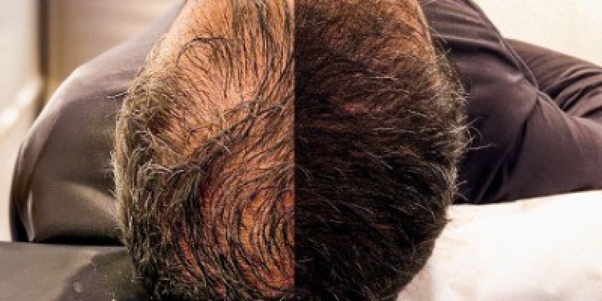 Restore Your Hair with Advanced Hair Transplant in Islamabad