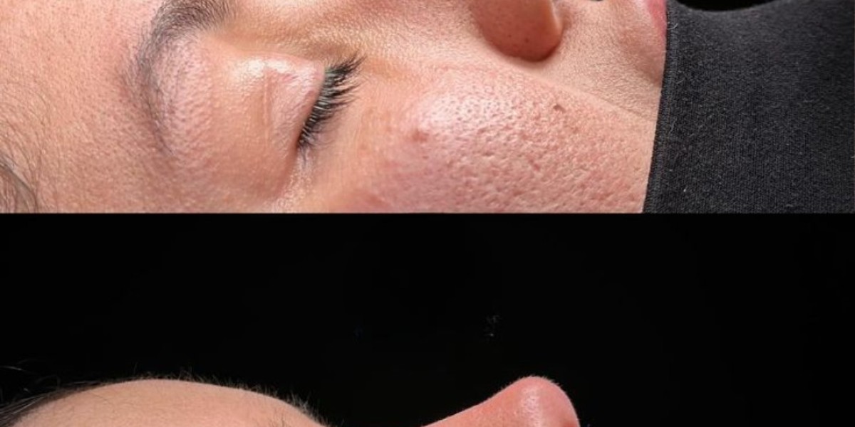 Achieve a Harmonious Look with Rhinoplasty in Islamabad