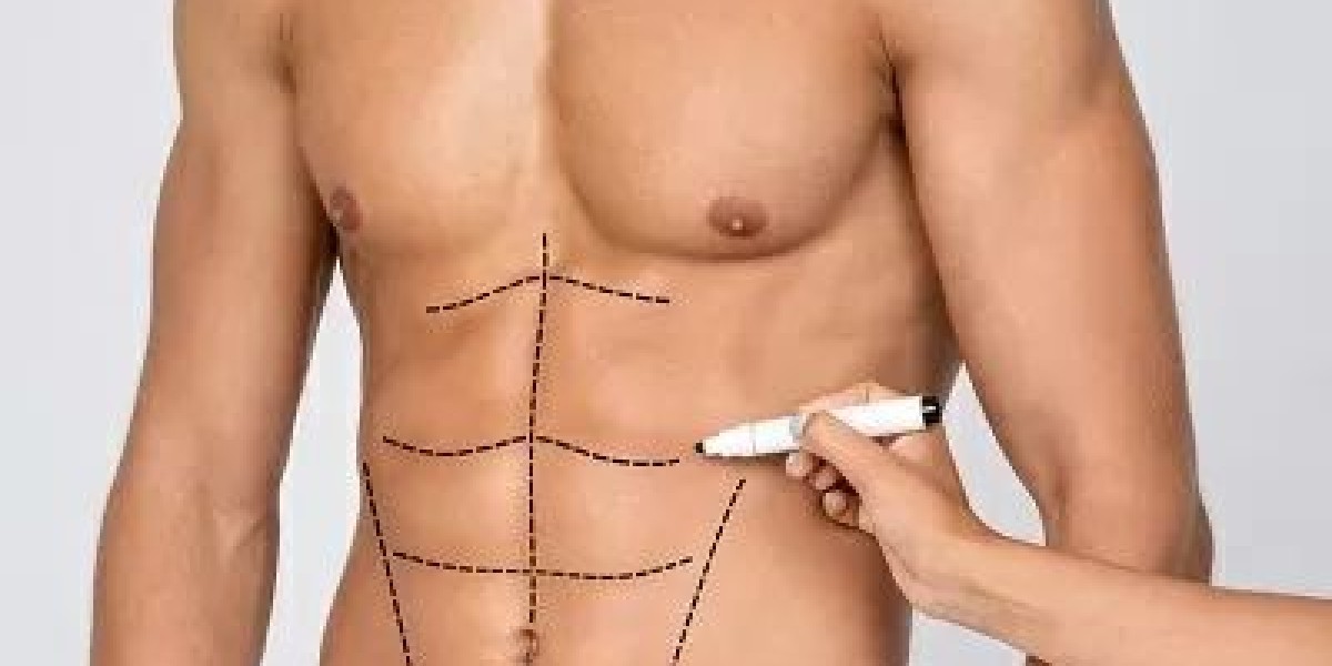 Liposuction in Islamabad: Precision Contouring for a Slimmer Body