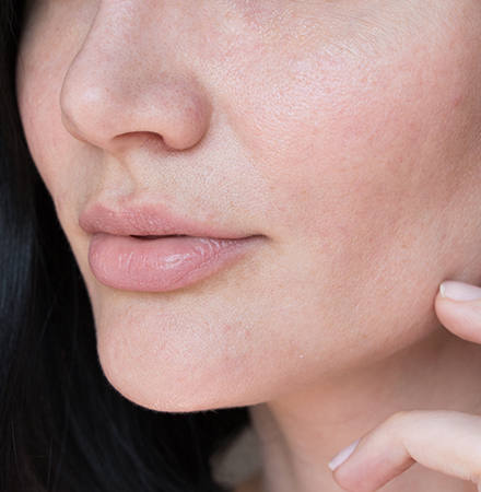 Botox Skin Treatment Singapore | Radium Medical Aesthetics