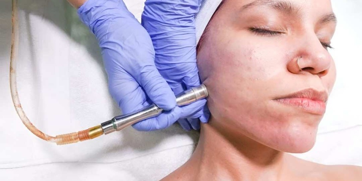 Microdermabrasion in Islamabad: Radiant Rebirth