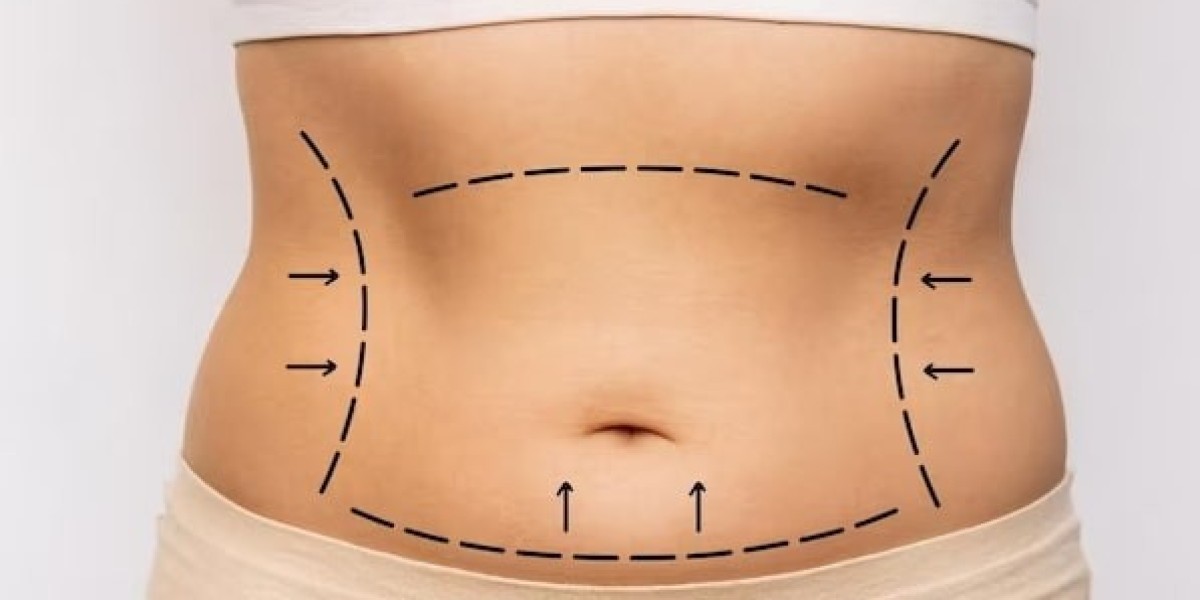 Advanced Tummy Tuck Treatment in Islamabad