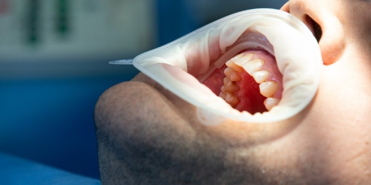 Dental Adhesive Market – Trends & Forecast 2035