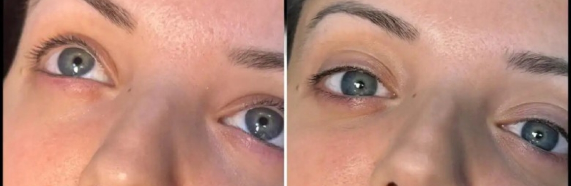 dermal fillers Cover Image