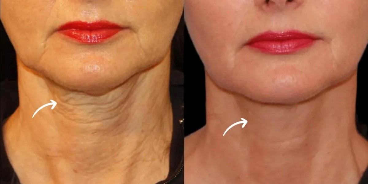 Best Plastic Surgeons in Dubai: Sculptra Emotional Benefits