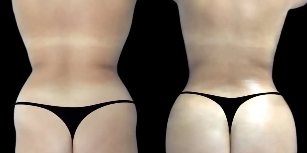 Best Plastic Surgeon in dubai: Hyacorp Fillers for Body Contouring