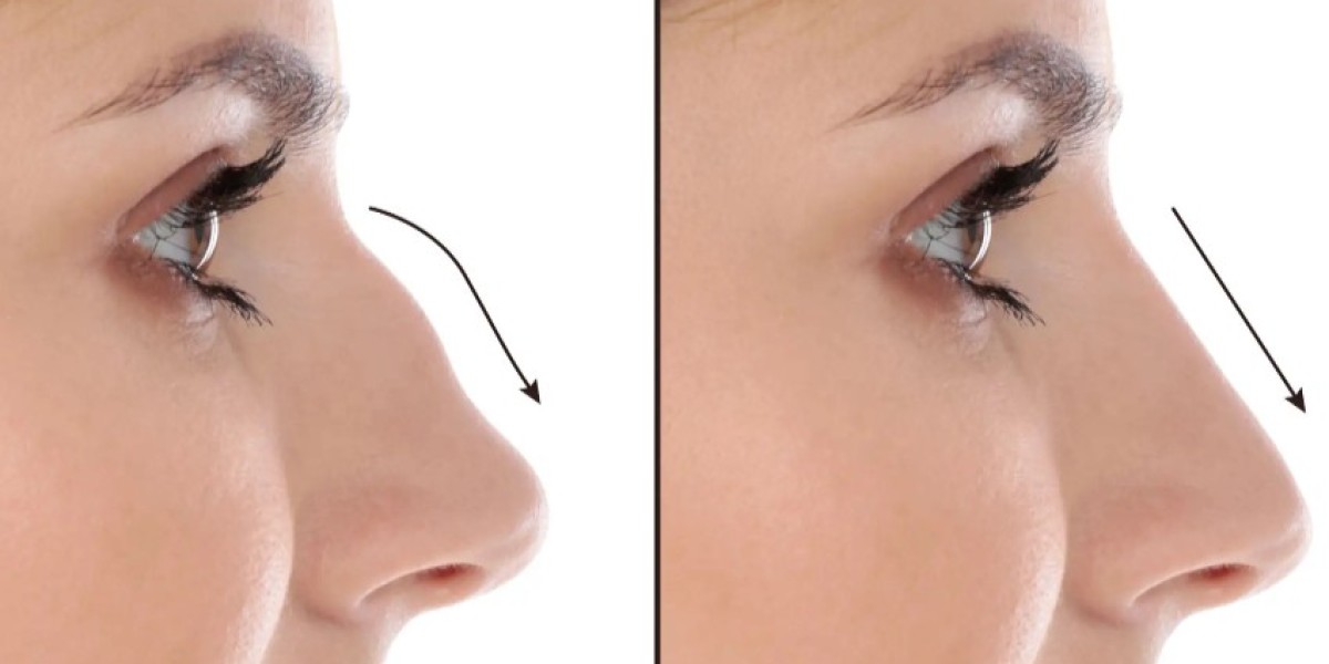 Best Septoplasty Surgeon in Dubai Using Modern ENT Methods