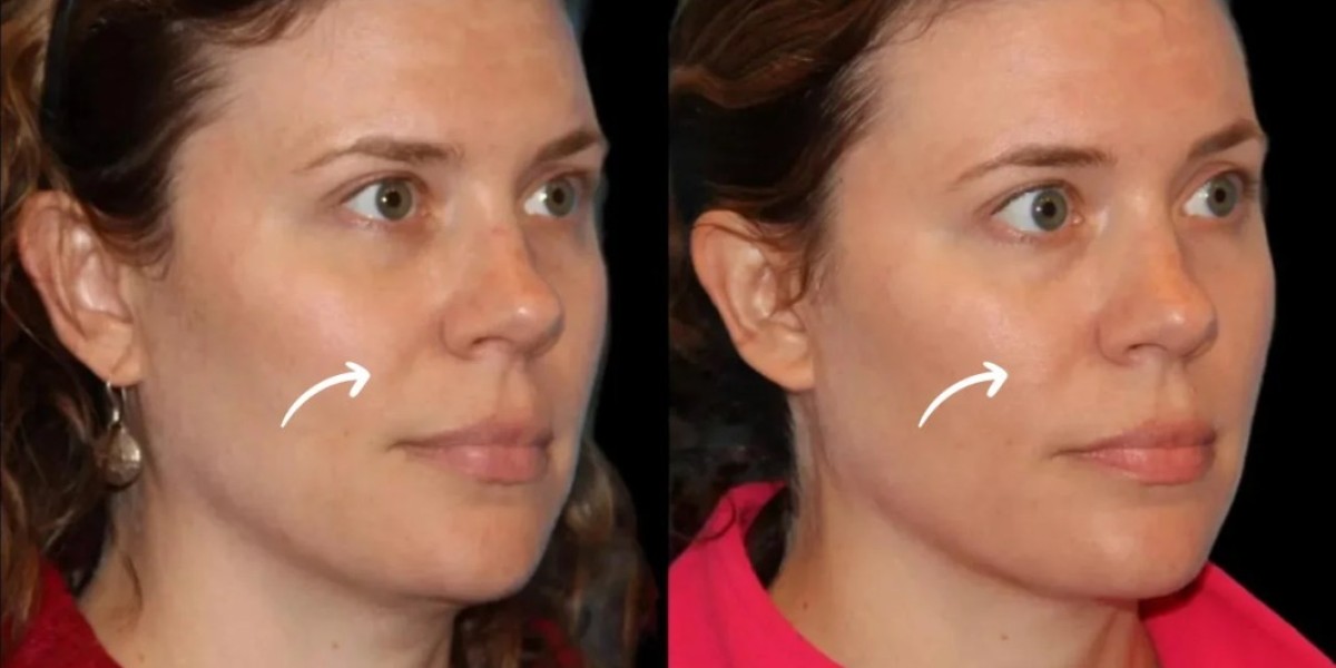 Best Doctors in Dubai on Sculptra for Muscle Cut Facial Loss