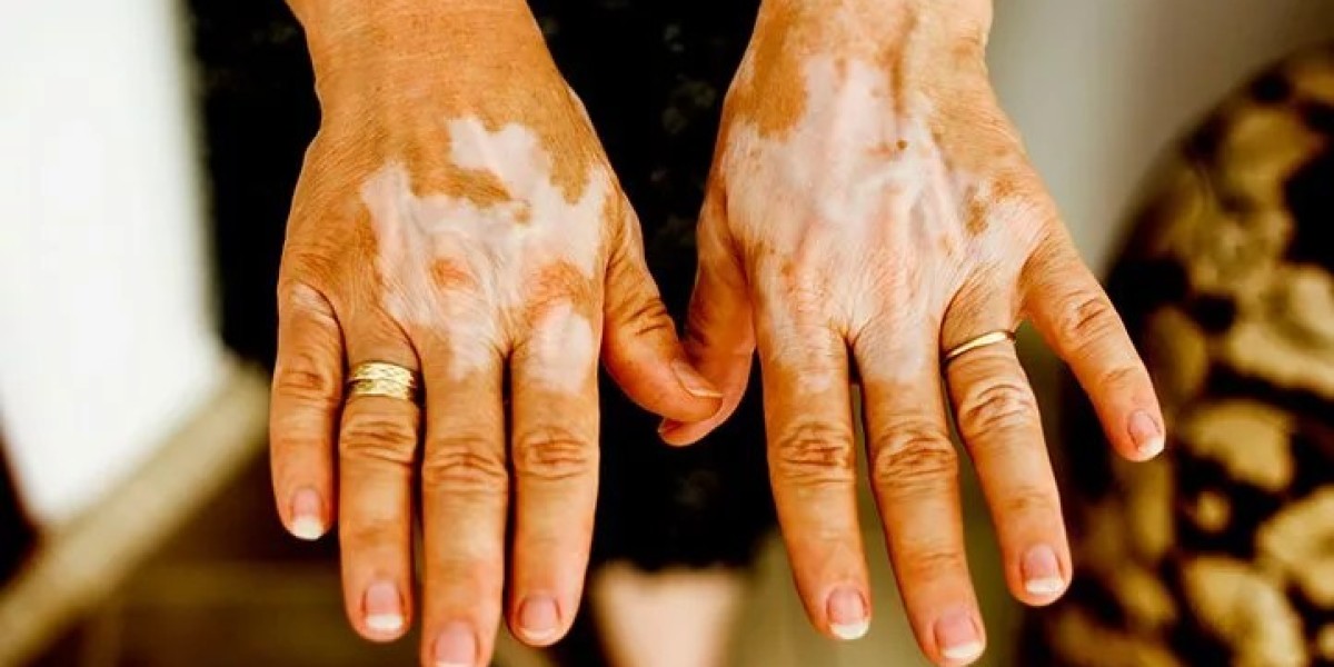 Professional Skin Care Solutions for Vitiligo in Islamabad