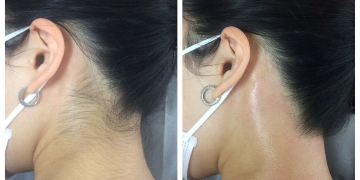 Effortless Hair Reduction with Laser Treatment