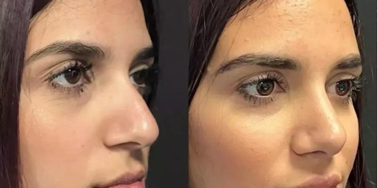 Best Rhinoplasty Surgeon in Dubai Focused on Patient Satisfaction