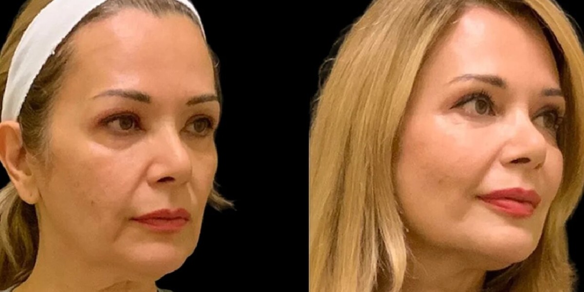 How to Maintain Results from Cheek Fillers Treatments in Dubai