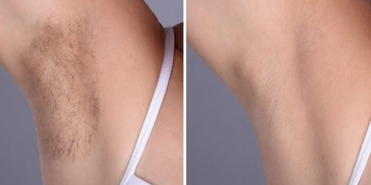 Laser hair removal Treatment in Dubai for Men and Women