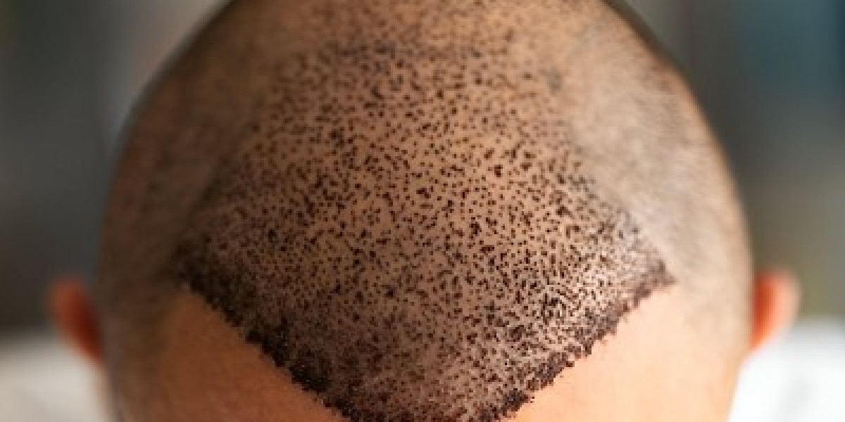 Cost Breakdown and Expectations for Hair Transplant in Islamabad