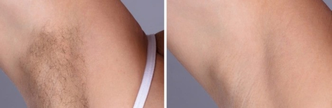 laserhair removal Cover Image