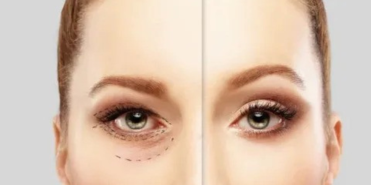 Eyelid Lift Surgery in Islamabad – Complete Overview