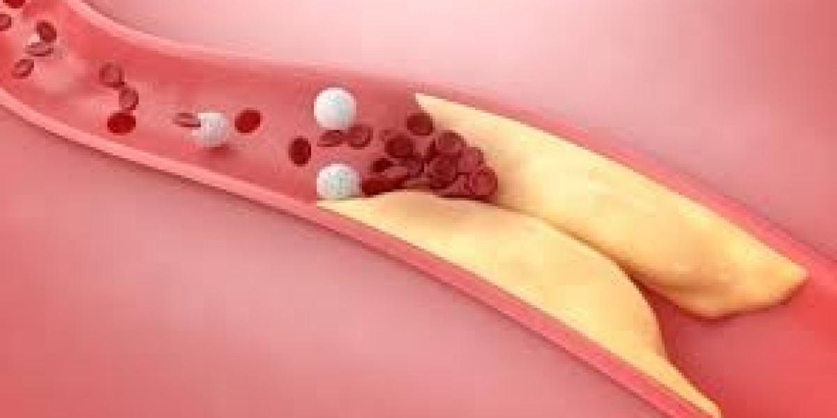 Early Warning Signs of High Cholesterolemia Dubai and When to Get Tested