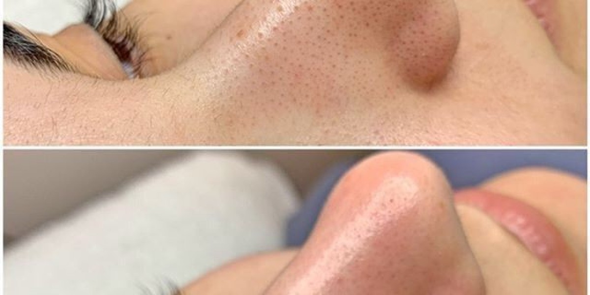 Hydrafacial in Islamabad: Transform Your Skin with Advanced Care