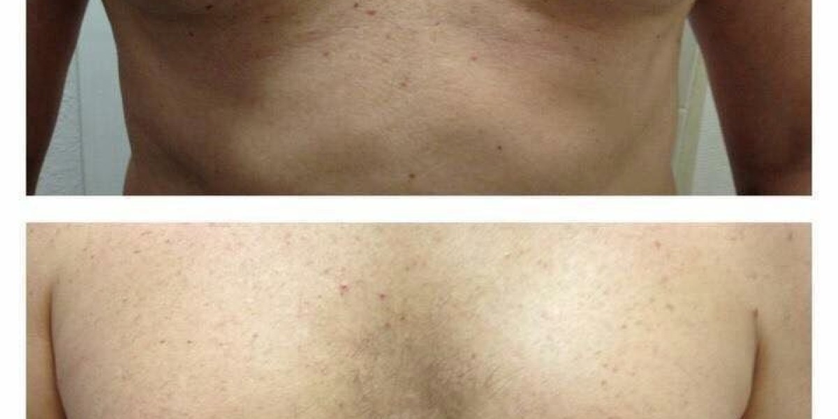 Gynecomastia in Islamabad: Restore a Flat and Masculine Chest