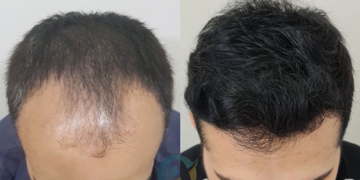 Hair Transplant in Islamabad: Restoring Hair and Confidence