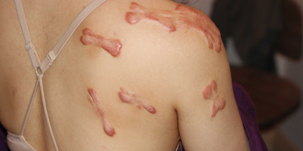 Why Professional Scar Removal Dubai Works Best