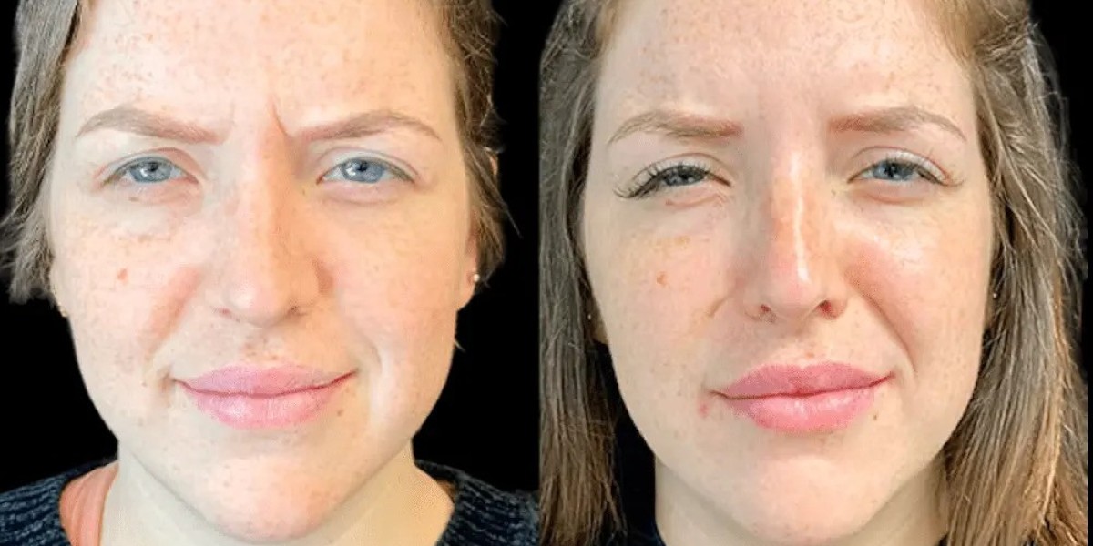 Best Plastic Surgeons in Dubai for Wrinkle Reduction with Botox