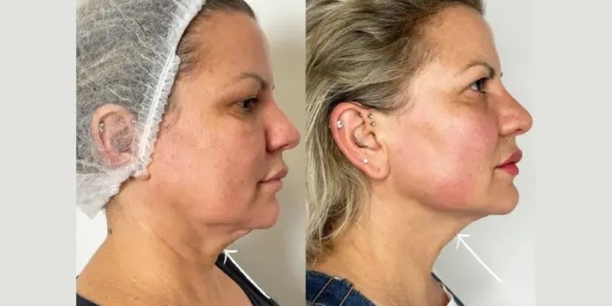 Endolift Treatments in Dubai vs Traditional Facelift Procedures