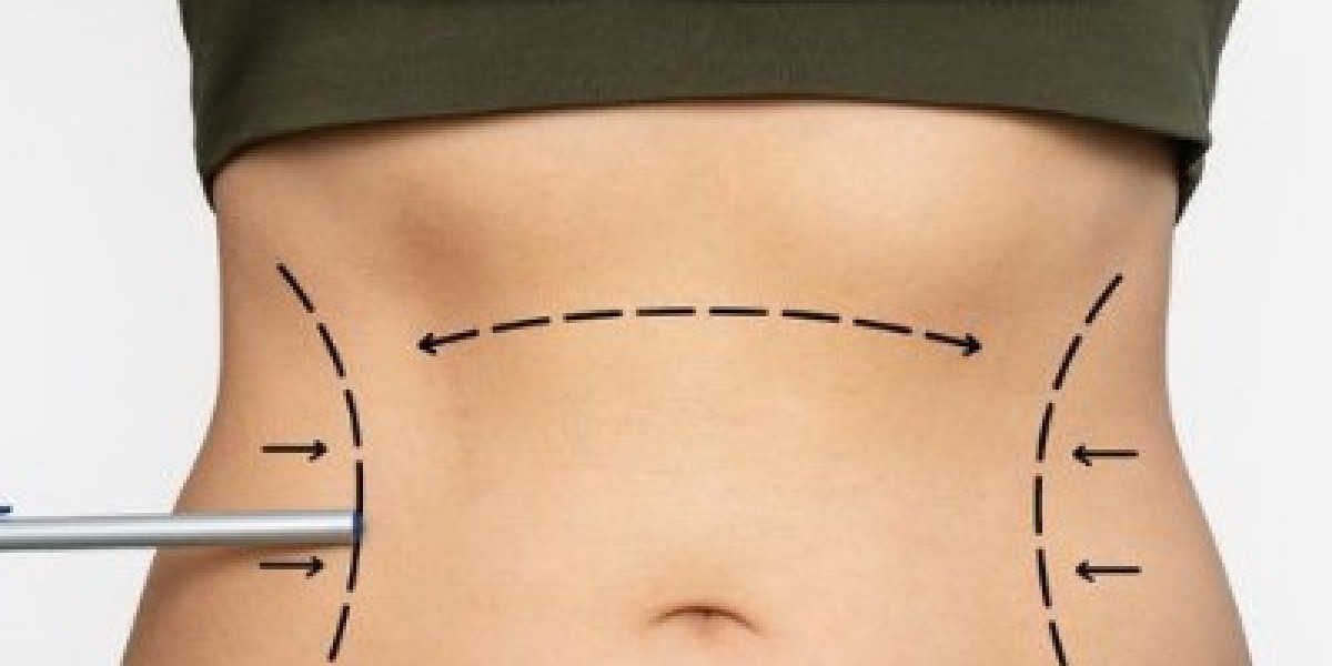 Tummy Tuck Surgery and Scar Minimization Techniques