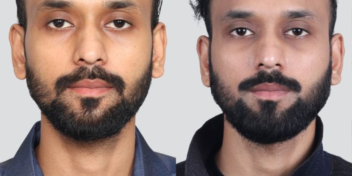 Hair Transplant in Islamabad: Restore Your Hair, Restore Your Confidence