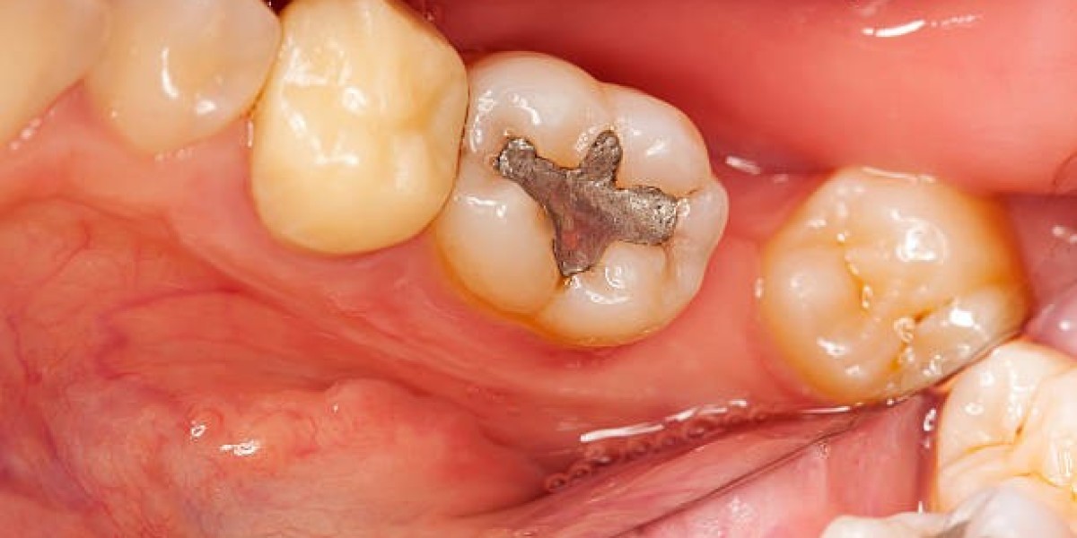 Early Care for Stronger, Healthier Teeth Dental Fillings :