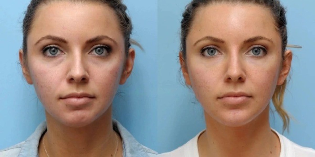 Best Plastic Surgeons in Dubai for Safe Anti-Aging Thread Lift