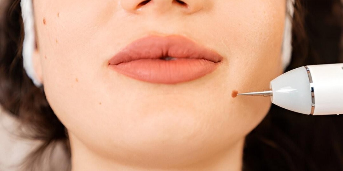 Elite Wart Removal in Islamabad – Quick Fix