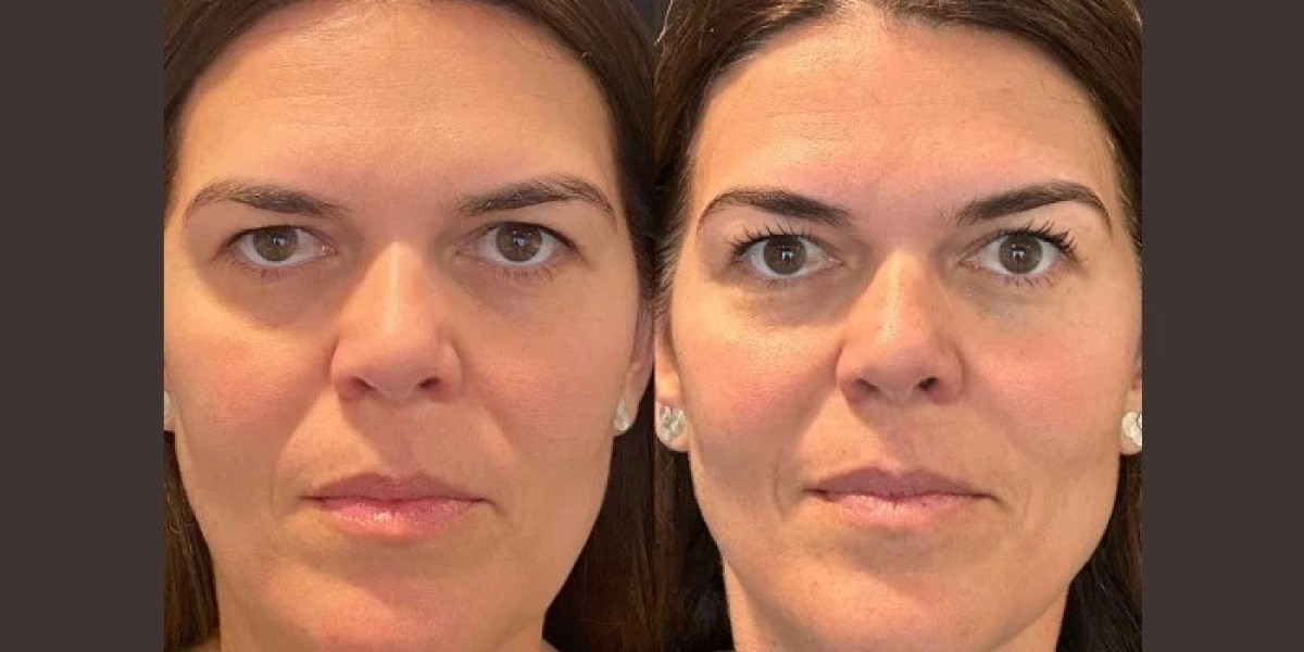 Best Plastic Surgeons in dubai Share Thread Lift Tips