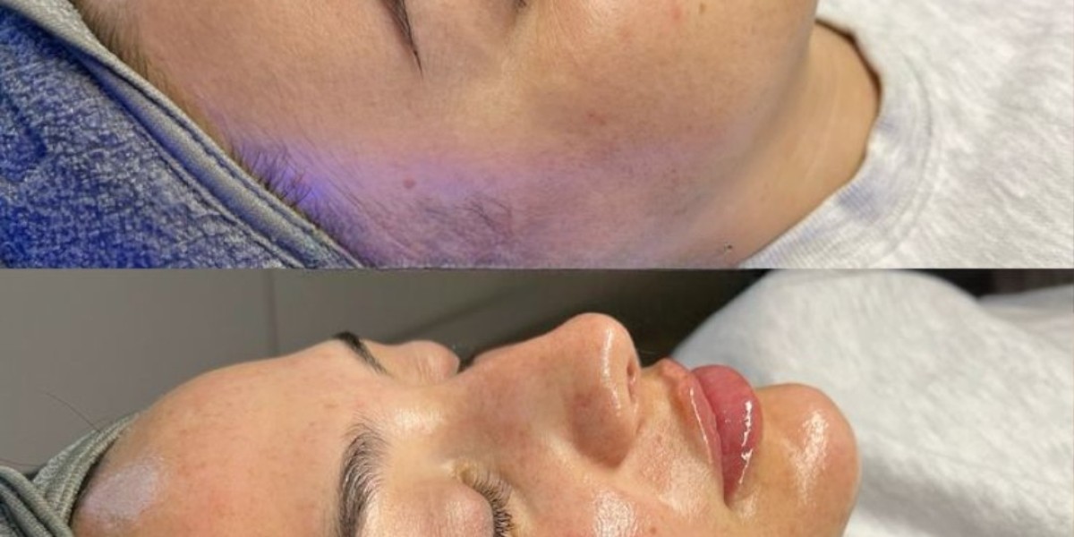 Non-Surgical Skin Tightening in Islamabad for Youthful Skin