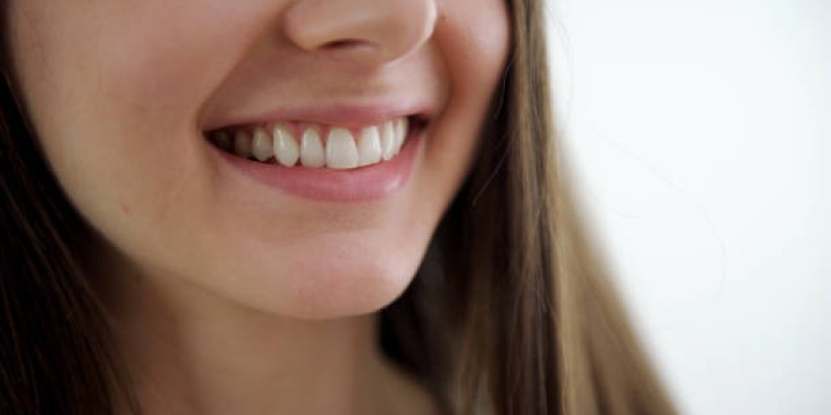 Hollywood Smile in Islamabad: Redefine Confidence with a Radiant Smile