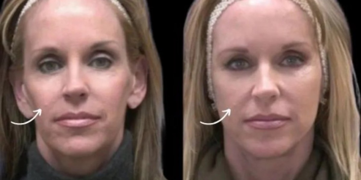 Best Plastic Surgeons in Dubai and Sculptra for Facial Muscle Support