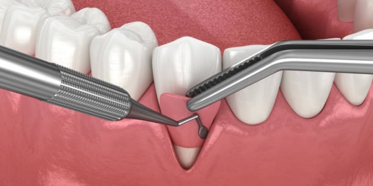 Gum Grafting in Islamabad: A Long-Term Solution for Receding Gums