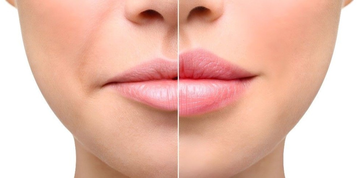 Lip Augmentation in Islamabad: Your Beauty Upgrade