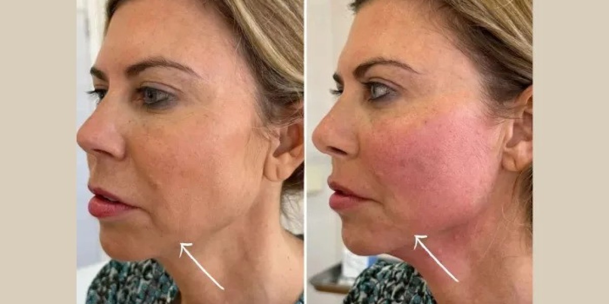 Best Aesthetic Clinics in Dubai on Endolift Safety and Precautions