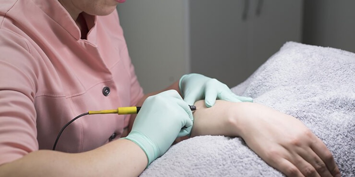 Electrolysis Laser Hair Removal in Dubai for Thick Hair